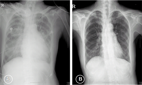 Figure 1 Chest X-ray showed cardiomegaly with pulmonary edema (A), Figure 1 Chest X-ray showed cardiomegaly with pulmonary edema (A),