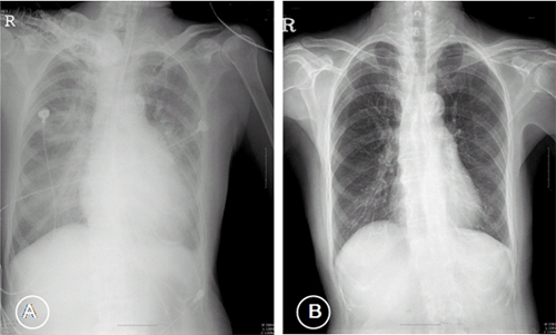 Figure 1 Chest X-ray showed cardiomegaly with pulmonary edema (A), 