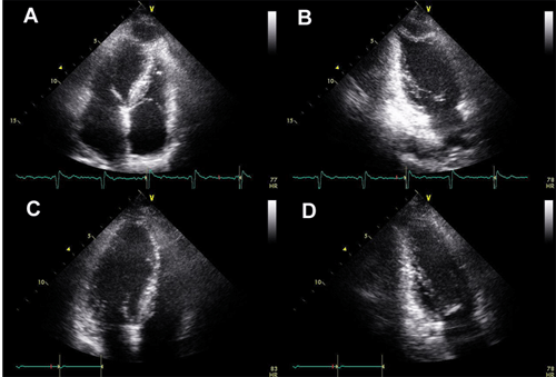 echocardiogram schemat